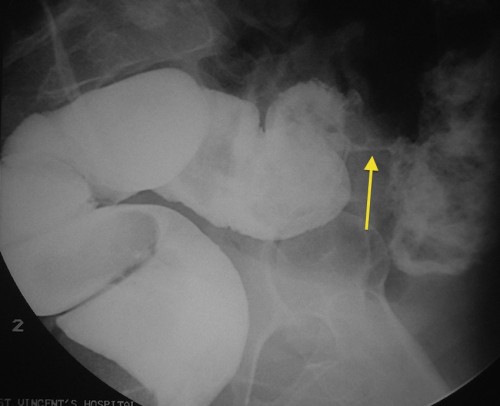 This is a coned image from a contrast enema showing an 'apple-core' lesion (arrow), characteristic of colon cancer. 