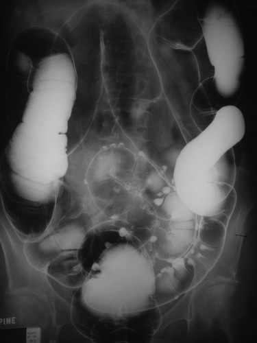 This is an image from a double contrast barium enema, showing sigmoid diverticular disease.