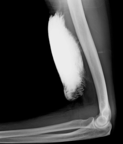 Radiograph performed following extravasation of a large volume of contrast during a CT examination. 