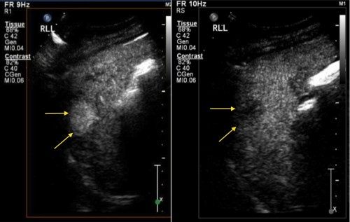 This patient with alcoholic liver disease had a routine ultrasound of liver showing a new hypoechoic lesion in the right lobe. CEUS was performed. The lesion demonstrated hyperenhancement, showing rapid uptake of the injected microbubbles resulting in the mass becoming hyperechoic (left-hand image). Subsequently, the lesion 'washes out', becoming hypechoic relative to the remainder of the liver parenchyma (right image). These enhancement characteristics are typical of hepatocellular carcinoma. 