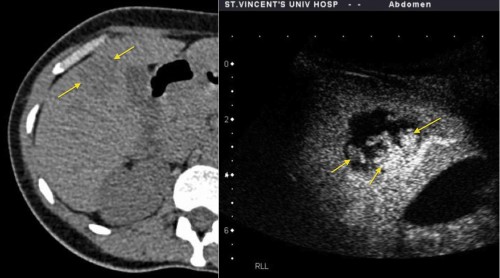 This young woman presented with renal colic and underwent a CT KUB, which showed an incidental lesion in the liver (arrows). CEUS was performed and showed nodular enhancement (arrows) at the periphery of the mass, characteristic of a haemangioma.  