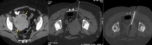 CT can also be used for guidance for biopsy of pelvic lesions. This patient previously had a hysterectomy for uterine leiomyosarcoma. Follow-up CT showed a large mass at the right pelvic side-wall (left image, arrows). Biopsy was requested. With the patient prone, a planning CT was performed, again with a grid taped to the patient's skin (middle image). Appropriate needle length was selected based on the depth of the mass from the skin. Right hand image shows the biopsy needle in the edge of the mass. The biopsy confirmed metastatic leiomyosarcoma.