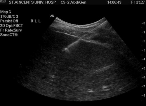 Image from an ultrasound-guided liver biopsy, showing the biopsy needle taking a core from the periphery of the liver. 