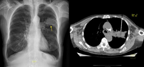 CT guided lung biopsy. This 73 year old smoker (note the hyperinflated lungs) has a large irregularly-shaped mass in the left upper lobe, suspicious for a primary lung tumour. An image from her CT-guided lung biopsy is shown on the right, displaying the biopsy needle at the edge of the mass.