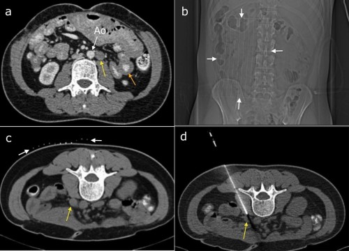 This patient's CT, (a), showed small bowel wall thickening (orange arrow) and retroperitoneal lymphadenopathy (yellow arrow, beside the abdominal aorta, Ao). The appearances were concerning for lymphoma and CT-guided biopsy was requested. To localize the correct skin site for needle insertion, a paper grid with radio-opaque lines drawn on it is taped to the skin (scout image (b), arrows). A scan through this region then allows the Radiologist to pick an appropriate slice (c) on which the lymph node is best visualized (yellow arrow). The grid (white arrows) allows selection of an appropriate site to insert the needle, which can then be advanced to the node (d). This is a hollow co-axial needle - a trucut core biopsy needle is then inserted through it and the biopsy samples obtained. Lymphoma was confirmed. 