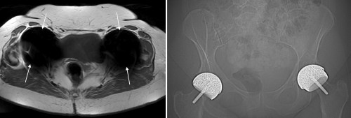 This transverse T1-weighted image (the urine in the bladder is dark) shows large areas of signal void (arrows) around both hips, which are due to the bilateral hip prostheses shown on the CT scout image on the right. The signal voids are much larger than the prostheses themselves, meaning that we could miss pathology immediately adjacent to the metal.