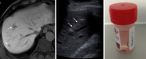 This patient was diagnosed with ocular melanoma. MRI liver, left, performed because of the suspicion of metastatic disease on staging CT, shows two probable metastases (arrows). A targeted ultrasound-guided liver biopsy was performed (middle image, needle indicated by arrows). The specimens this yielded are in the pot of formaldehyde on the right. Note how the majority of the tissue in both samples is black - this is due to the presence of melanin.