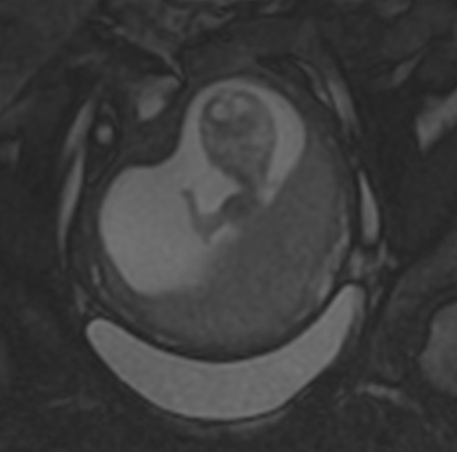 Another MRI during pregnancy. This fetus is taking the opportunity to wave at the outside world for the first time. You can see a video of this here.