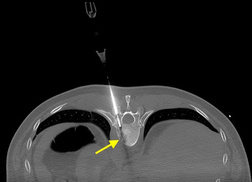 This image is taken from a CT-guided spine biopsy, performed to confirm that the lytic lesion in T10 (arrow) was a metastasis from the patient's known neck cancer. The biopsy needle has been drilled through the pedicle of the vertebra, just a few millimetres from the spinal cord. Steady hand required!