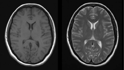 The left-hand image is T1-weighted, the one on the right is T2-weighted.