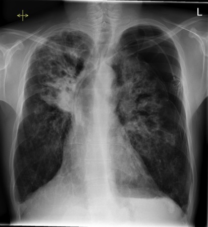 Tension pneumothorax in CF patient