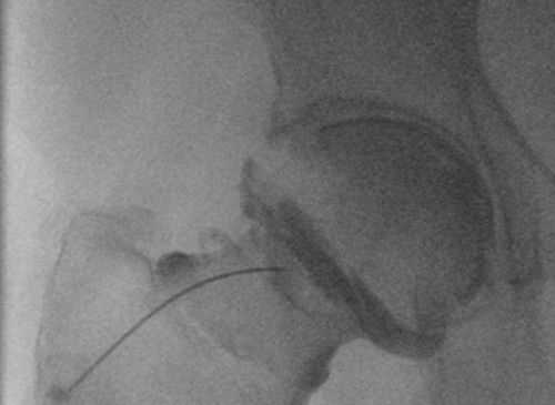 Image from a fluoroscopy-guided hip injection; iodinated contrast has been injected into the joint through a spinal needle. 