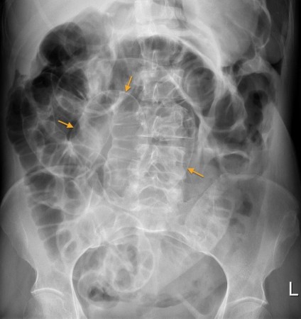 Pneumoperitoneum – Rigler’s sign – PFA