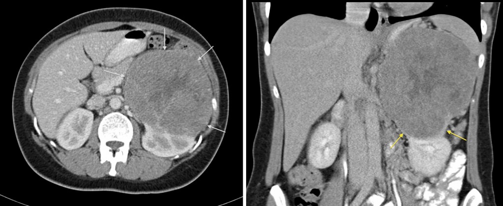 Renal Cell Carcinoma (2) - Radiology at St. Vincent's University Hospital