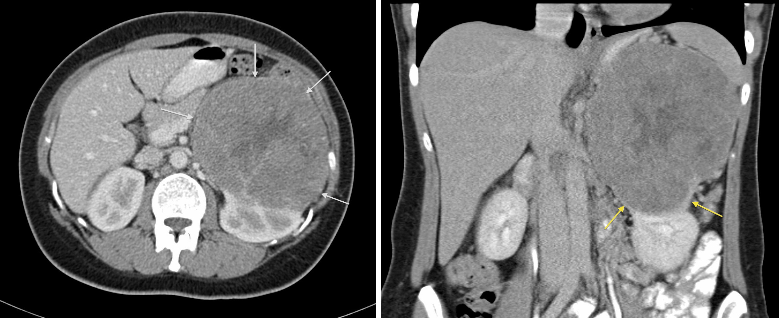 Renal Cell Carcinoma 2 Radiology At St Vincents University Hospital