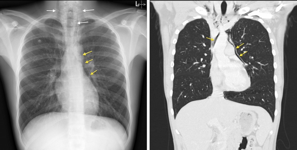 Pneumomediastinum - CXR and CT - Radiology at St. Vincent's University