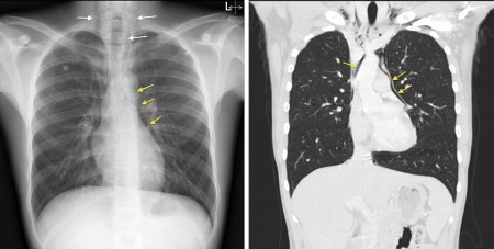 Pneumomediastinum – CXR and CT