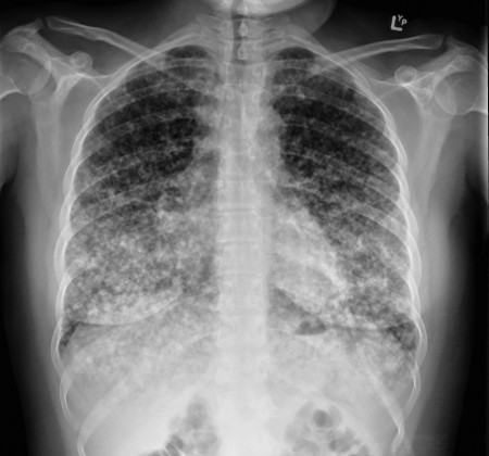 Miliary metastases – CXR