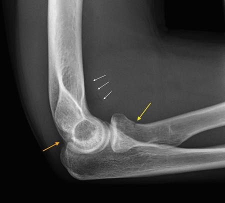 Radial neck fracture - Radiology at St. Vincent's University Hospital