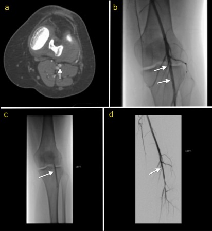 Popliteal artery angioplasty – embolus