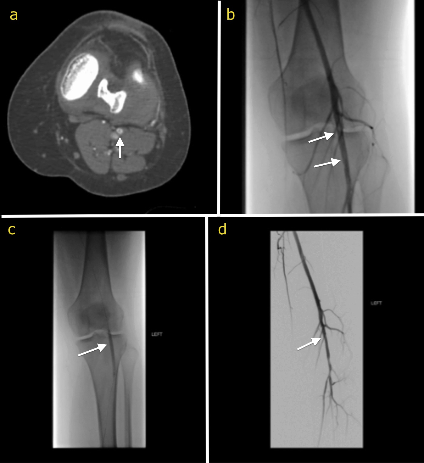 angiography of popliteal artery icd 10