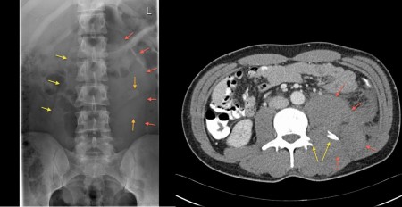 Retroperitoneal haemorrhage – PFA/CT