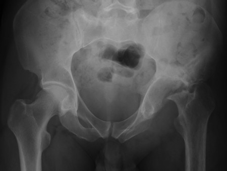 Septic arthritis – hip