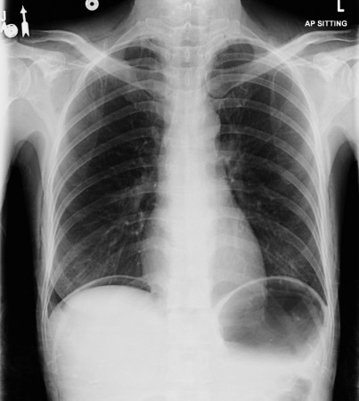 Pneumoperitoneum – erect CXR (2)