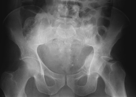 Hip dislocation, central