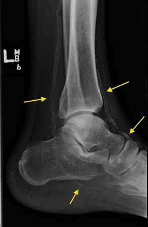 Arterial calcification in a diabetic