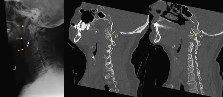 C2 fracture – XR and CT