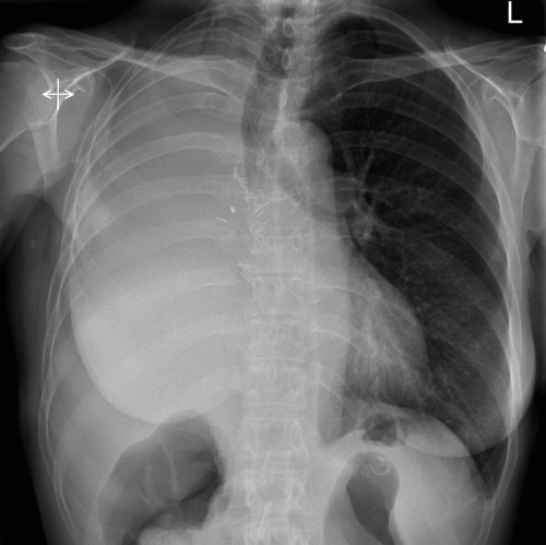 Left Lower Lobe Collapse Cxr Radiology At St Vincents University