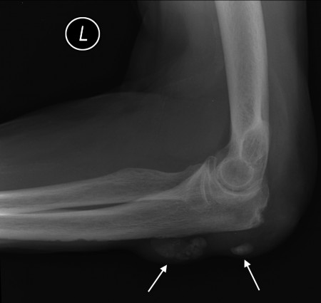 Chronic tophaceous gout – elbow