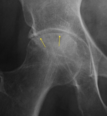 Avascular necrosis – subchondral collapse