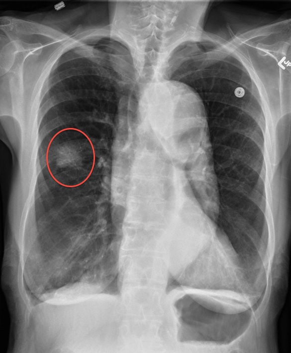 Lung cancer case study of a patient