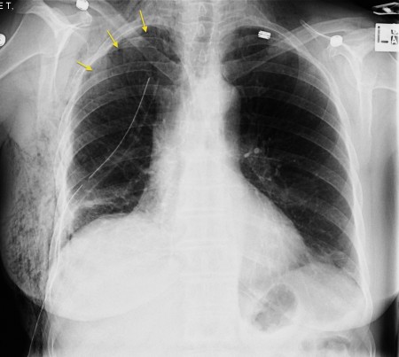 Pneumothorax and surgical emphysema