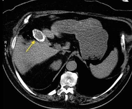 Porcelain gallbladder