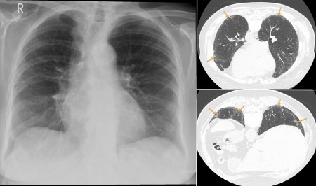 Interstitial lung disease – UIP