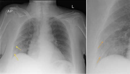 Rib Fractures