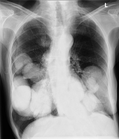 Cannonball metastases – CXR