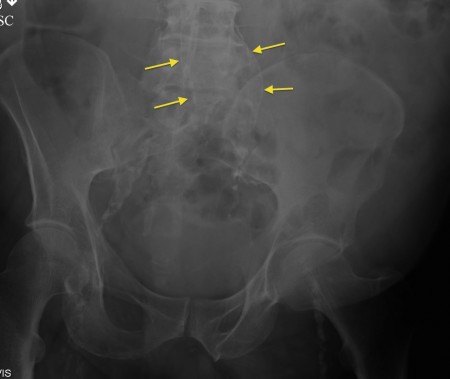 AAA on pelvic x-ray