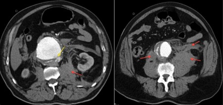 Ruptured Aortic Aneurysm