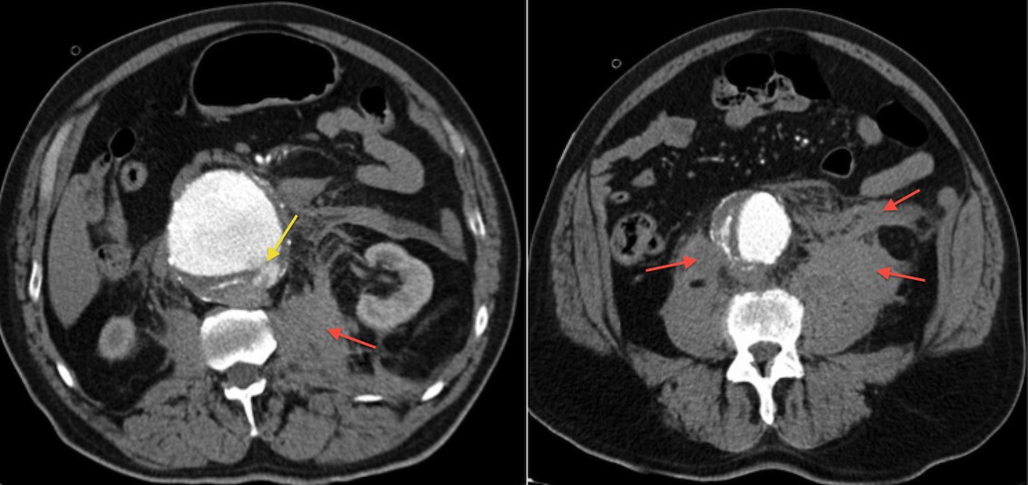 ruptured thoracic aortic aneurysm ct
