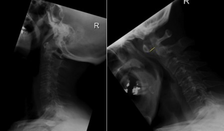 Atlanto-axial subluxation