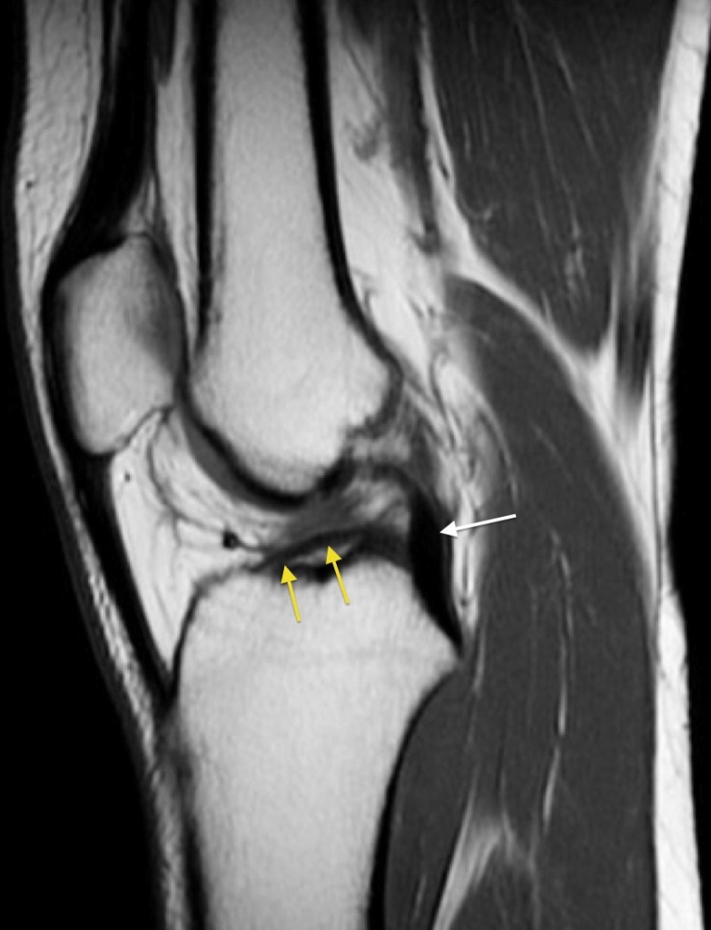 ACL tear - Radiology at St. Vincent's University Hospital