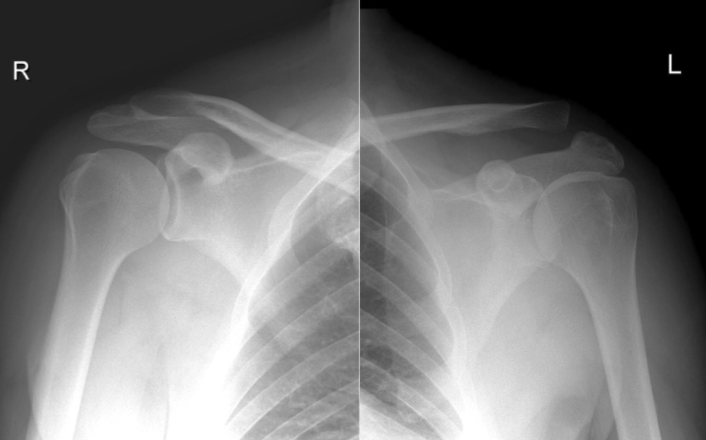 Acromioclavicular separation - Radiology at St. Vincent's University
