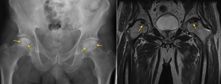 AVN – x-ray and MRI