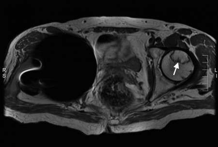 Avascular necrosis – MRI