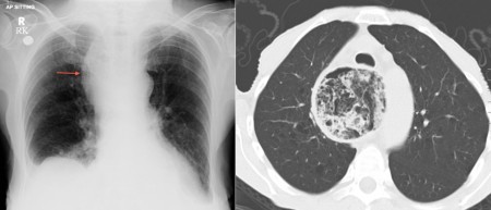 Achalasia – CXR and CT