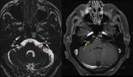 Acoustic neuroma